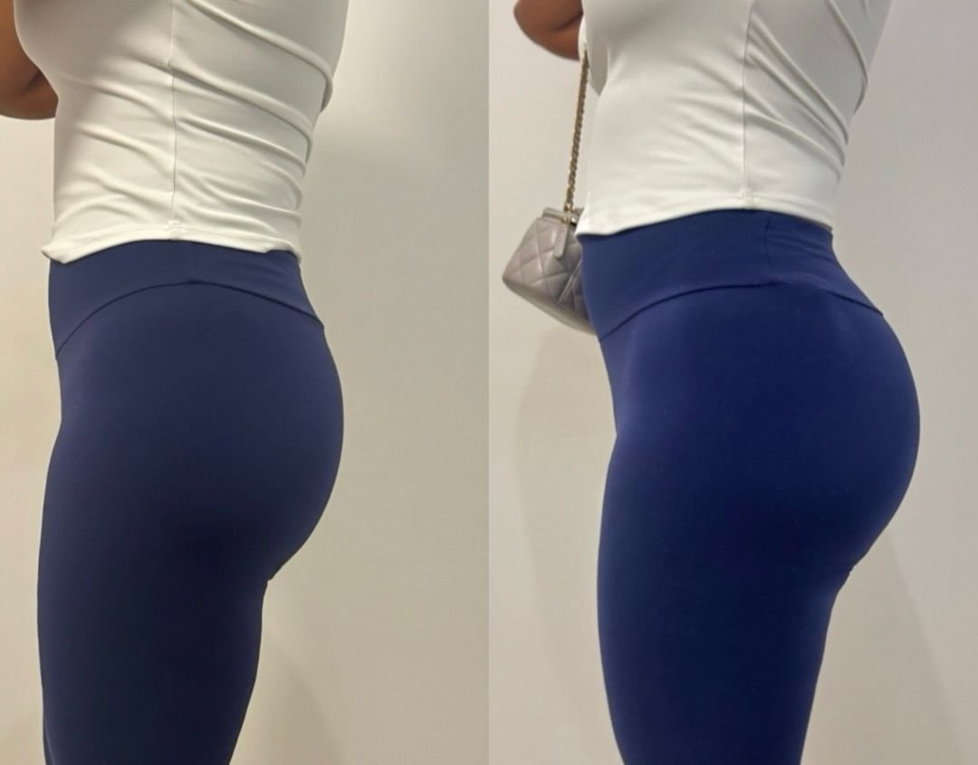 Before and after body filler case 4